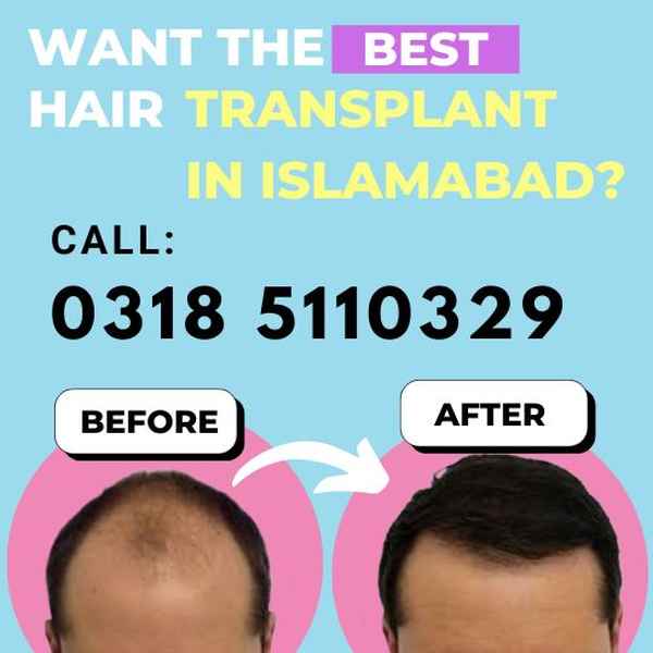 best hair transplant in islamabad